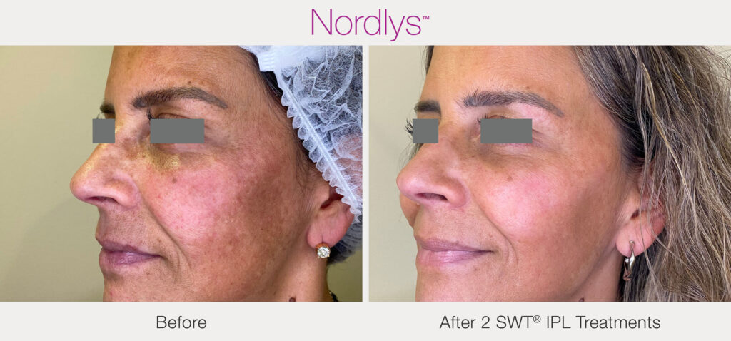 Nordlys IPL facial in Mequon